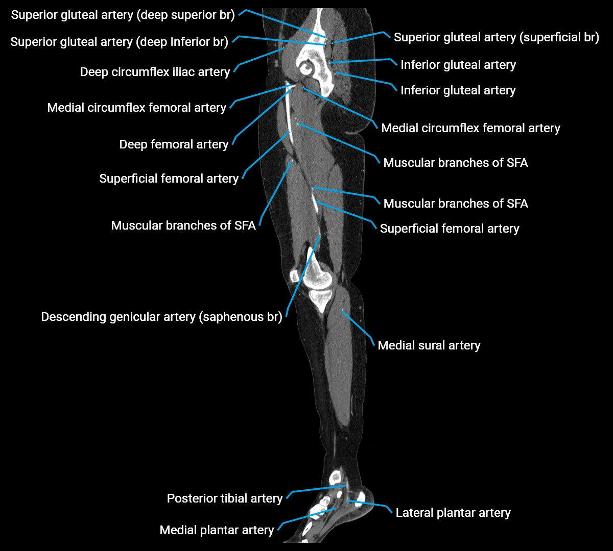 CTA lower limb sagittal cross sectional anatomy labelled image _32 (3).webp